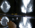 Mammogram