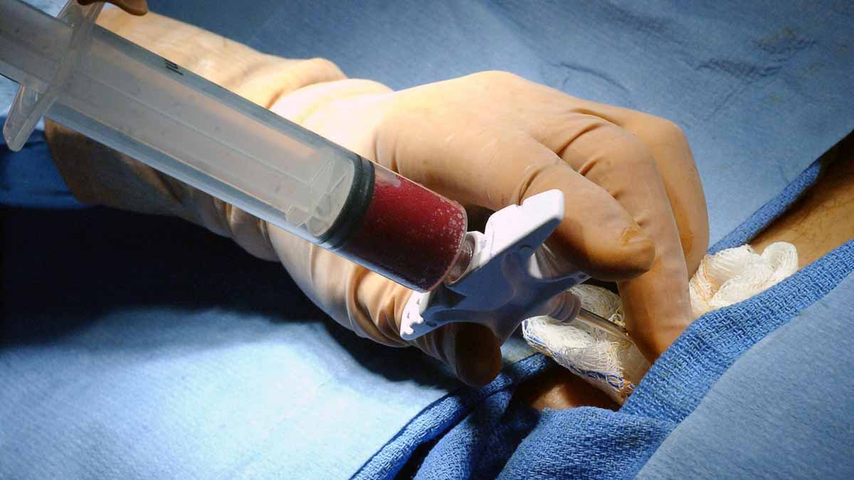 A bone marrow harvest. (<a href=