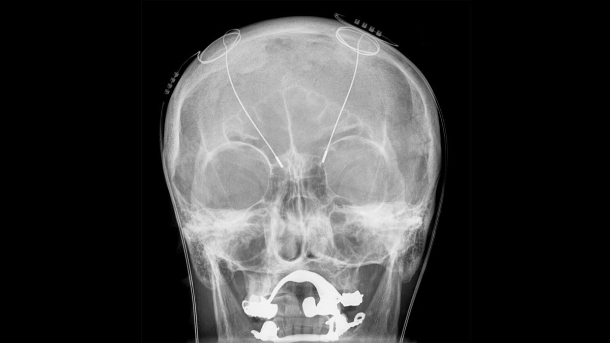 DBS probes shown in an X-ray of the skull.(Hellerhoff/Wikimedia commons)