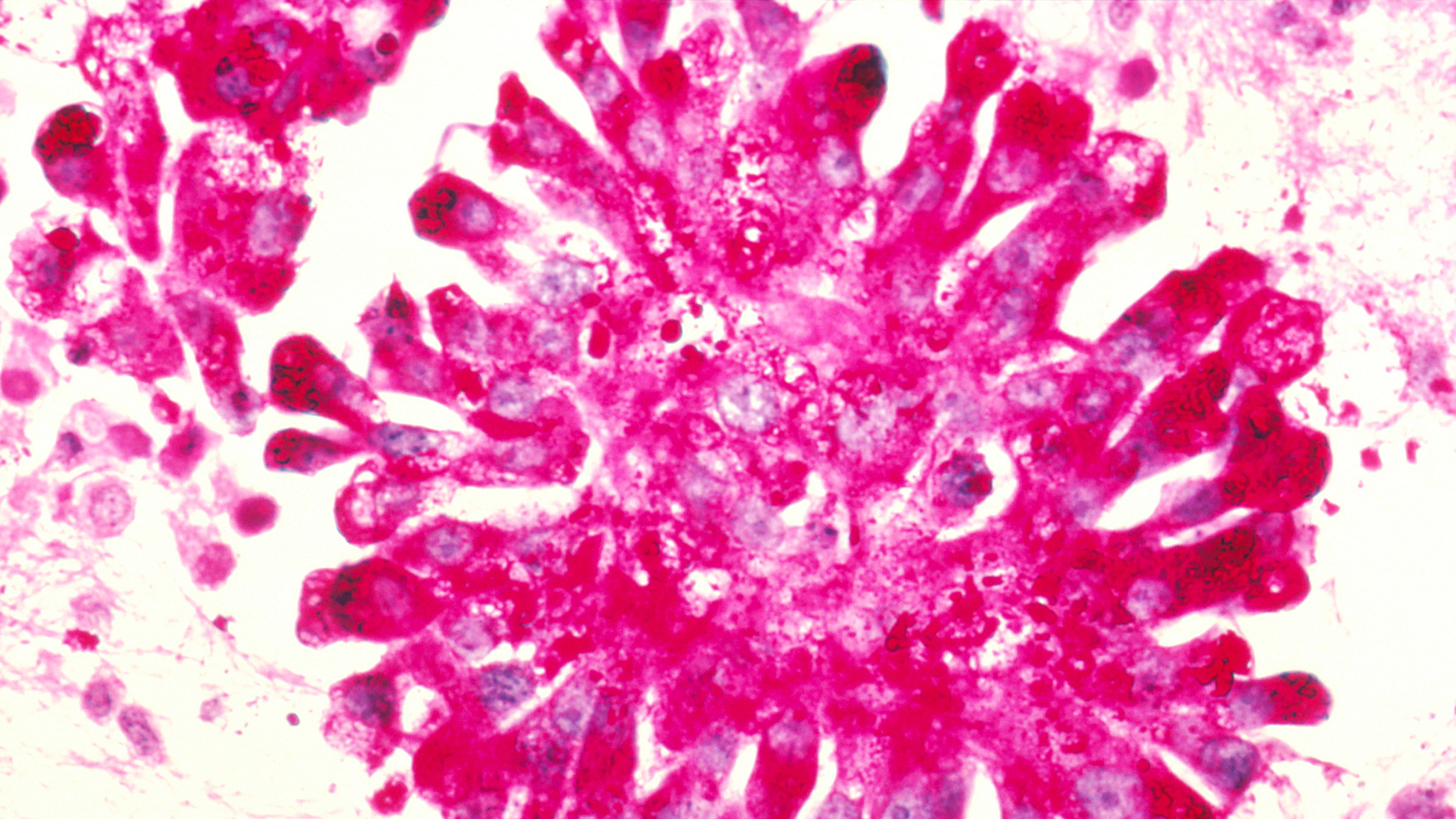 This slide from the Dr. Lance Liotta Laboratory shows Ewing's sarcoma