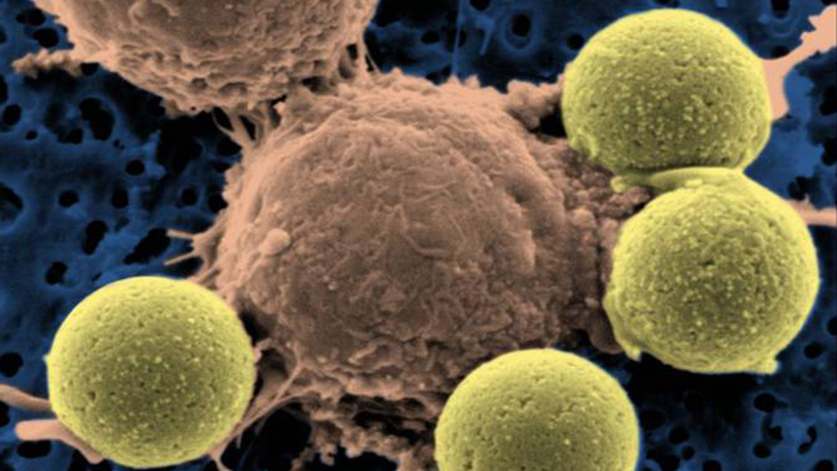 This microscopy image provided by Dr. Carl June shows immune system T-cells