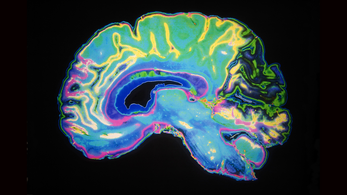 An artificially colored MRI scan of a human brain. (<a href=