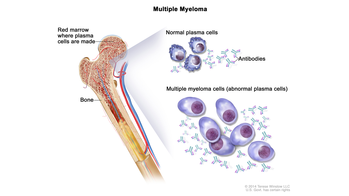 Multiple myeloma cells are abnormal plasma cells (a type of white blood cell) that build up in the bone marrow and form tumors in many bones of the body. (Image via NIH/Cancer.gov) 