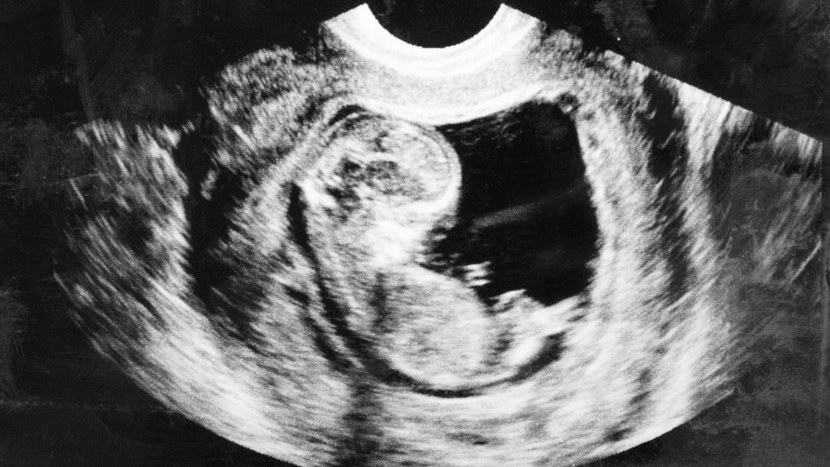  Diagnosis of Down syndrome can occur as early as the first trimester of pregnancy.(<a href=http://www.shutterstock.com/pic-124682011/stock-photo-fetus-month-in-the-womb.html?src=qkZtVUYNLZHEXLmG6fYWbg-1-34