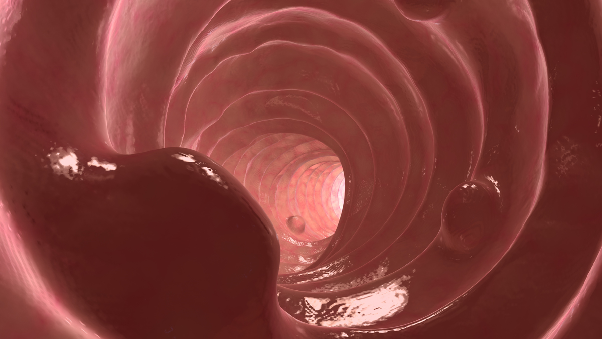  Polyps line the colon walls.(<a href=