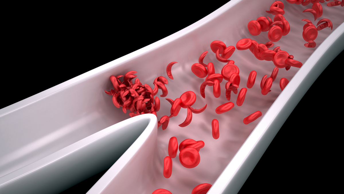  Sickle cell disease results from a mutation in hemoglobin — the protein that carries oxygen in the blood — that causes red blood cells to be crescent-shaped.(Shutterstock) 