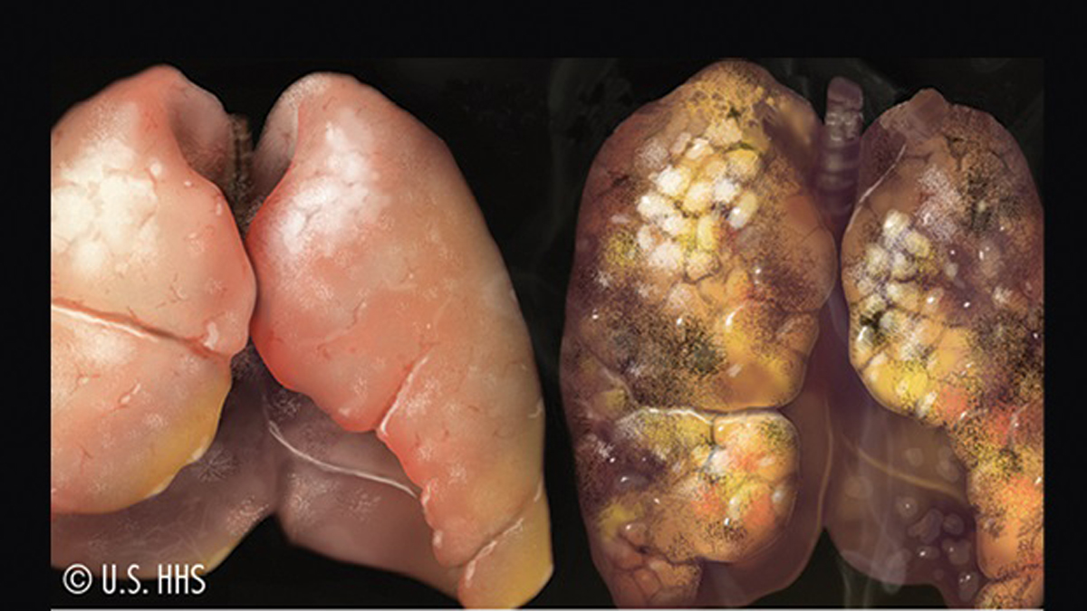 This cigarette warning label image produced a high “emotional reaction” among participants in the study. (Photo courtesy of the Annenberg Public Policy Center)
