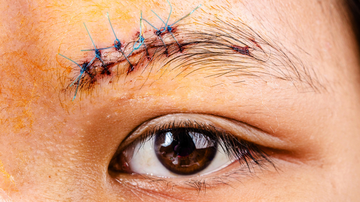 Researchers at the University of Pennsylvania have discovered a way to make wounds heal differently
