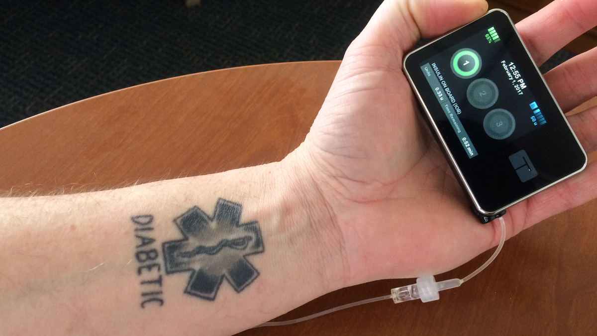  Justin Wood, who has Type 1 diabetes, tested an experimental artificial pancreas. (Alan Yu/ WHYY) 