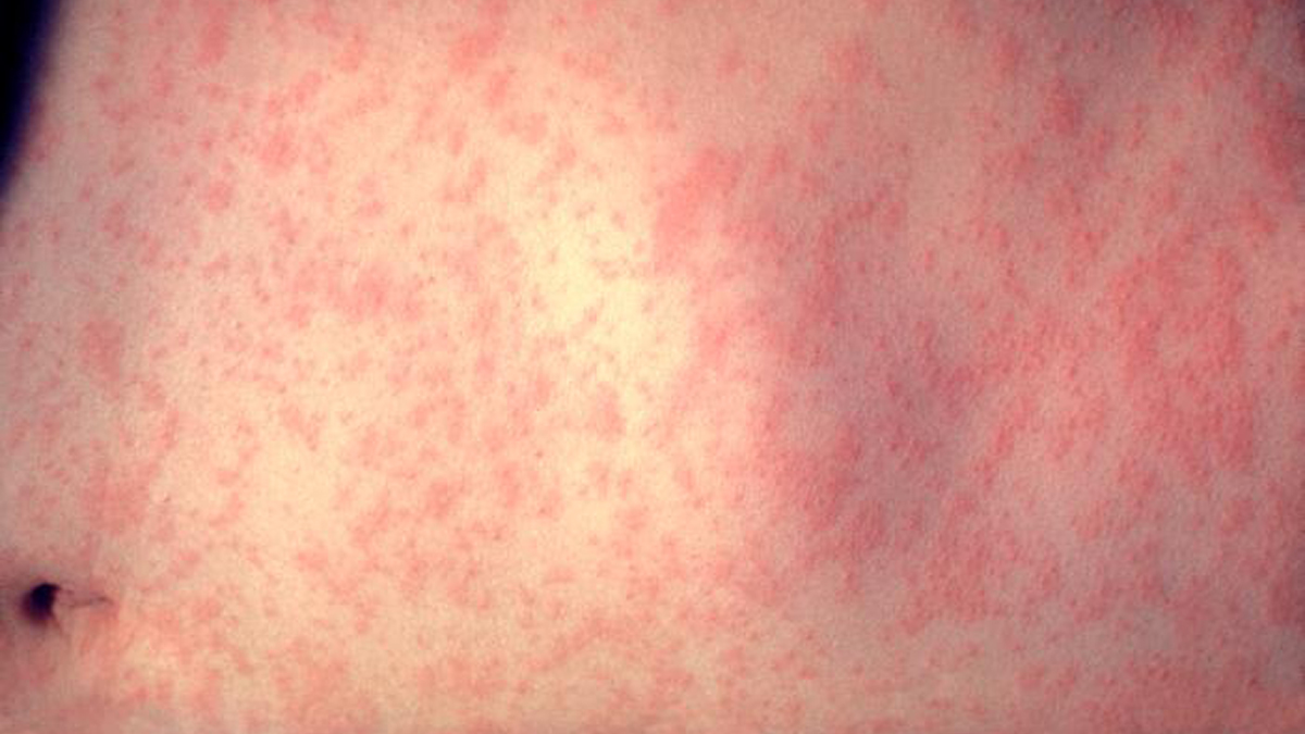  This is the skin of a patient after three days of measles infection. (Image courtesy of CDC/ Heinz F. Eichenwald, MD) 