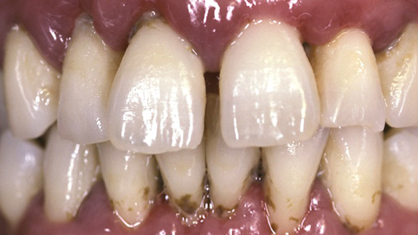 PennDental periodontitisx600