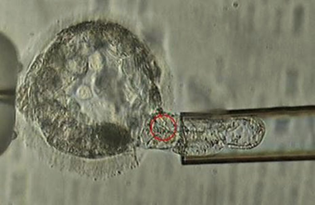 Choosing Your Baby This undated microscope image provided by the American Society for Reproductive Medicine in January 2018 shows a trophectoderm biopsy, in which cells from the outer layer of an embryo that develop into the placenta and amniotic membranes are removed and can be used for genetic testing. When a couple is known to be at risk for having a child with a specific genetic disorder, the woman undergoes a procedure to remove some of her eggs. After fertilization, some cells can be plucked from the embryos and examined to identify those without carry the disease-causing abnormality. (ASRM via AP)