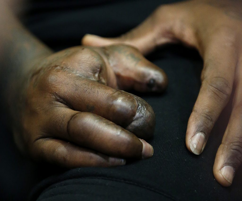 Jason Pierre-Paul In this Oct. 30, 2015, file photo, the hand of New York Giants defensive end Jason Pierre-Paul is seen as he speaks to reporters for the first time since a fireworks injury disabled his right hand, in East Rutherford, N.J. (Julio Cortez/AP Photo, file)