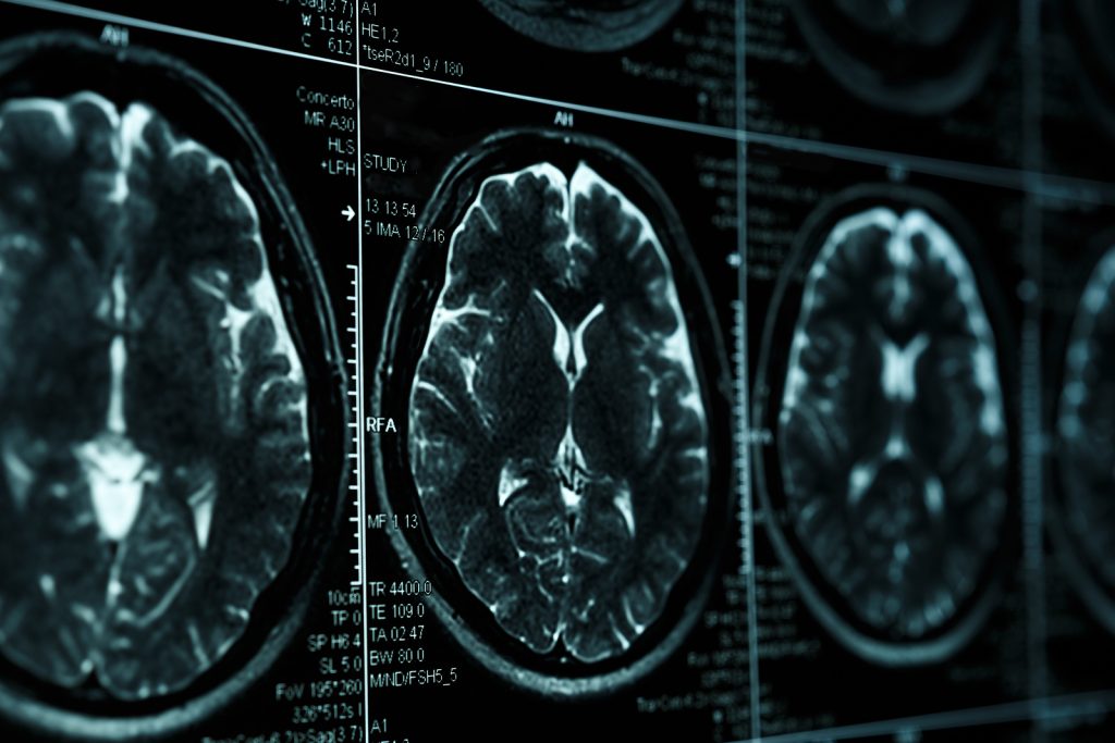 bigstock–173583320 Damage caused by traumatic brain injuries isn’t just the result of the physical blow, but it is connected to the release of a neurotransmitter called glutamate. But the brain has a natural defense against damage caused by glutamate — a compound called cypin. (Bigstock/DedMityay)