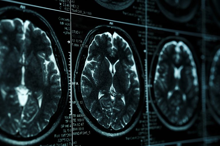 Damage caused by traumatic brain injuries isn’t just the result of the physical blow, but it is connected to the release of a neurotransmitter called glutamate. But the brain has a natural defense against damage caused by glutamate — a compound called cypin. (Bigstock/DedMityay)