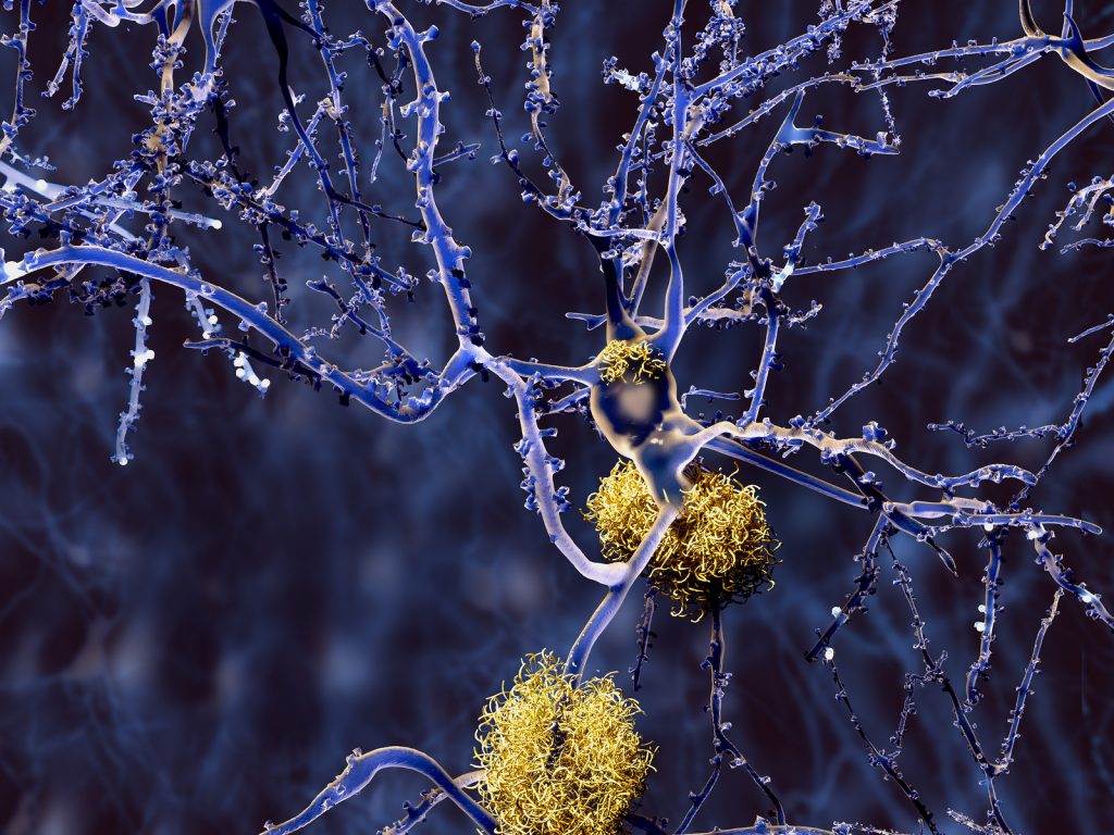 Alzheimer disease, neurons with amyloid plaques Amyloid plaques accumulate outside neurons