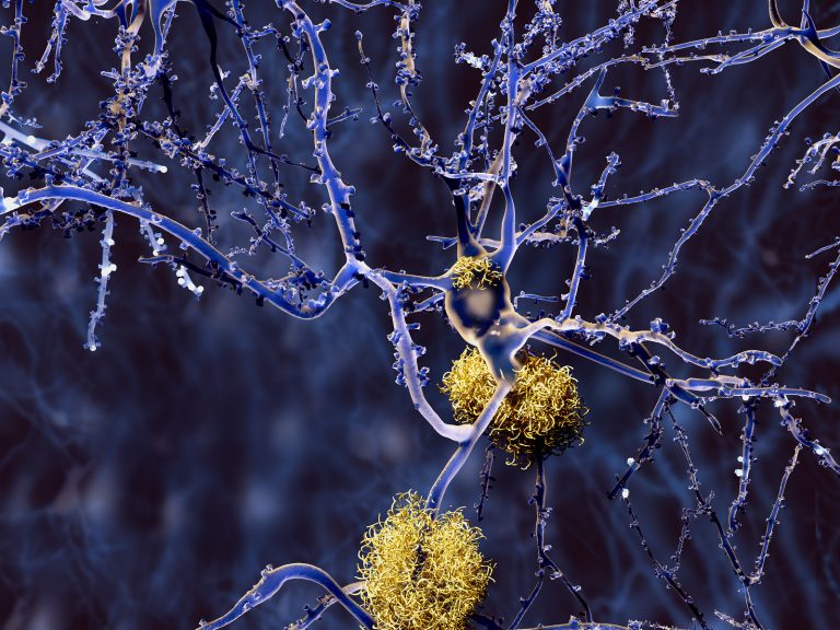 bigstock-Alzheimer-disease-neurons-wit-98977745-768×576 Amyloid plaques accumulate outside neurons. Amyloid plaques are characteristic features of Alzheimer's disease. (Animaxx3d/BigStock)