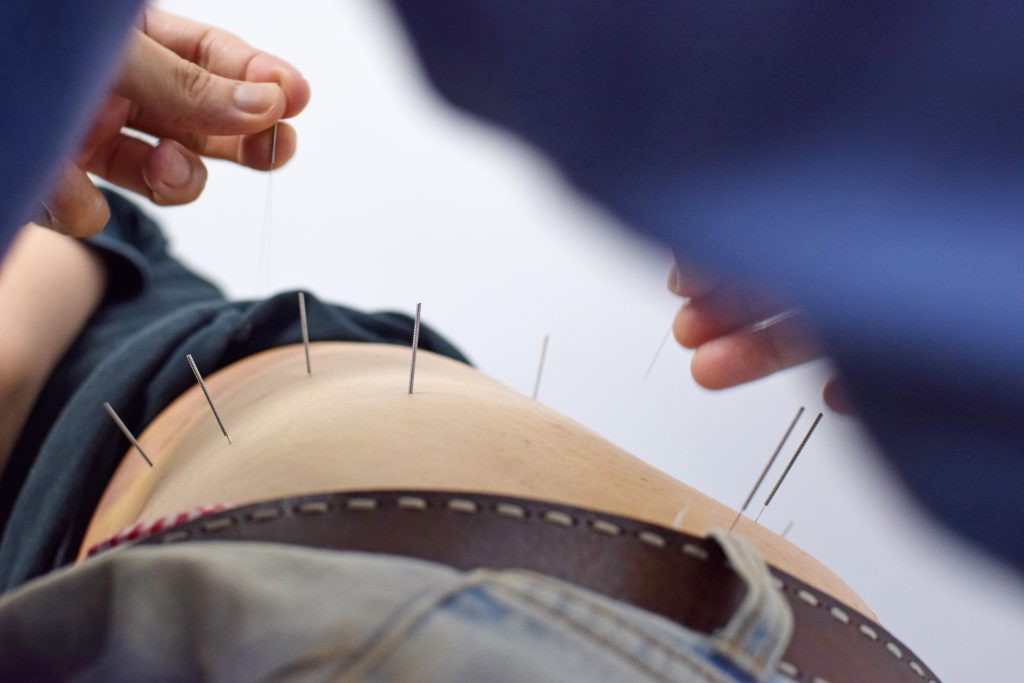 DSC_3758 An acupuncturist in Hong Kong treats a man for hip and leg pain. (Elaine Ng)