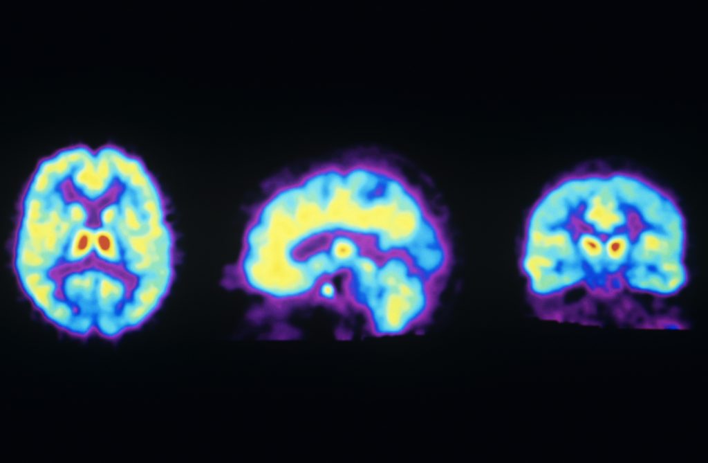 These PET scans show the normal distribution of opioid receptors in the human brain. A new study suggests ketamine may activate these receptors, raising concern it could be addictive. These PET scans show the normal distribution of opioid receptors in the human brain. A new study suggests ketamine may activate these receptors, raising concern it could be addictive. (Philippe Psaila/Science Source)