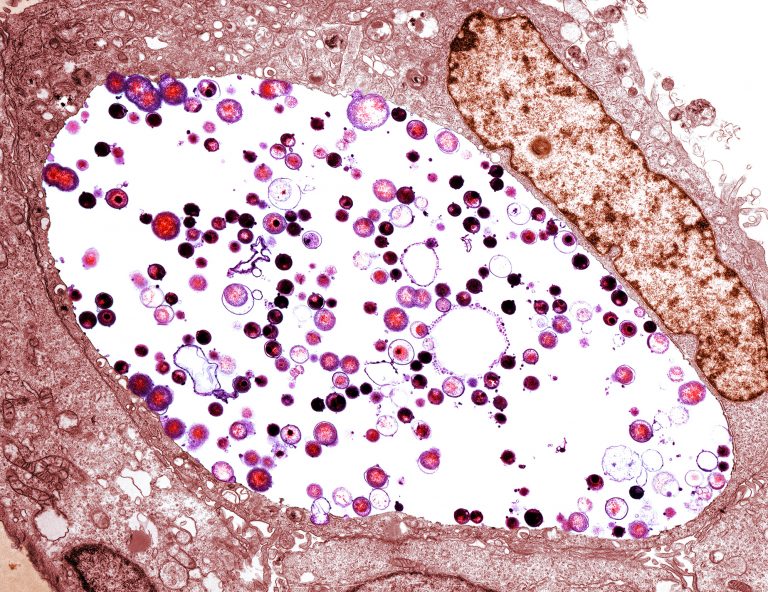 A tinted transmission electron micrograph of Chlamydia trachomatis bacteria (light purple/black) inside a cell. Chlamydia is the most common sexually transmitted disease in the U.S., with more than 1.7 million reported cases in 2017. (Biomedical Imaging Unit, Southampton General Hospital/Science Source)
