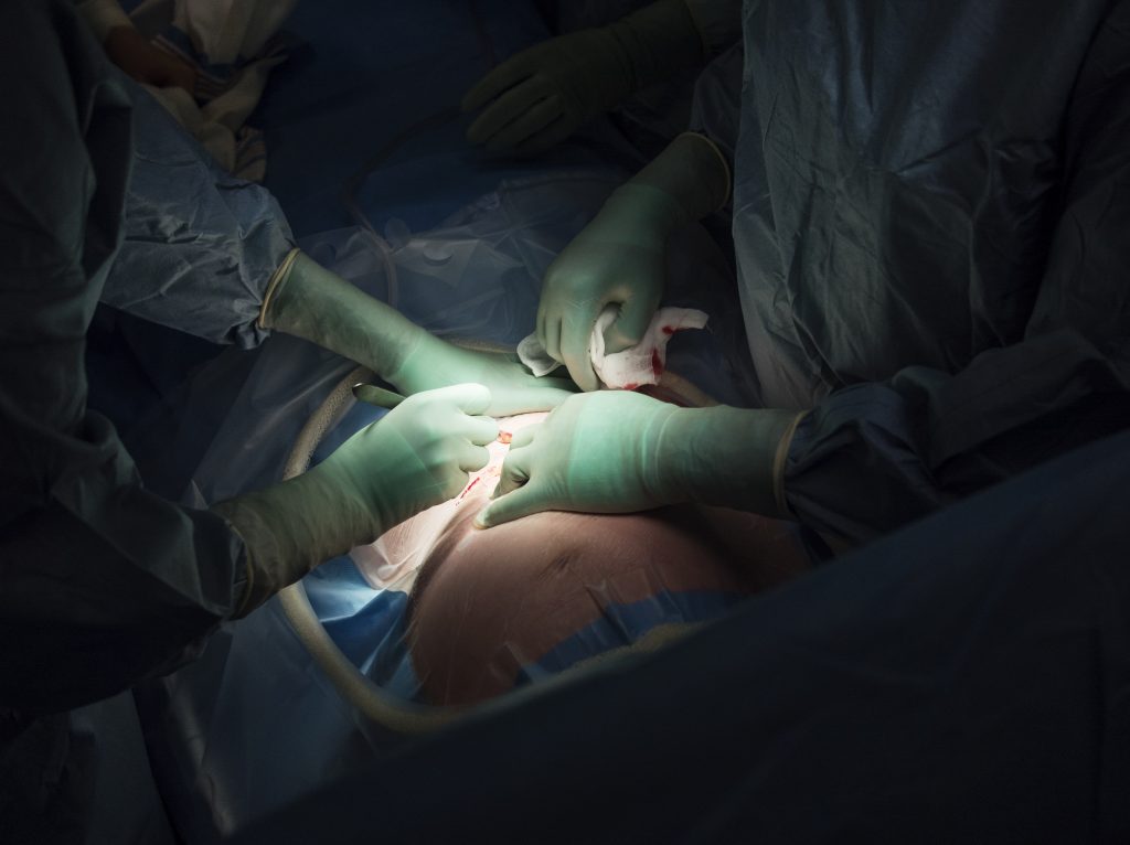 Surgeons perform a cesarean section. A new report raises concerns about rising rates of this procedure around the world, from Brazil to China. Surgeons perform a cesarean section. A new report raises concerns about rising rates of this procedure around the world, from Brazil to China. (Getty Images)