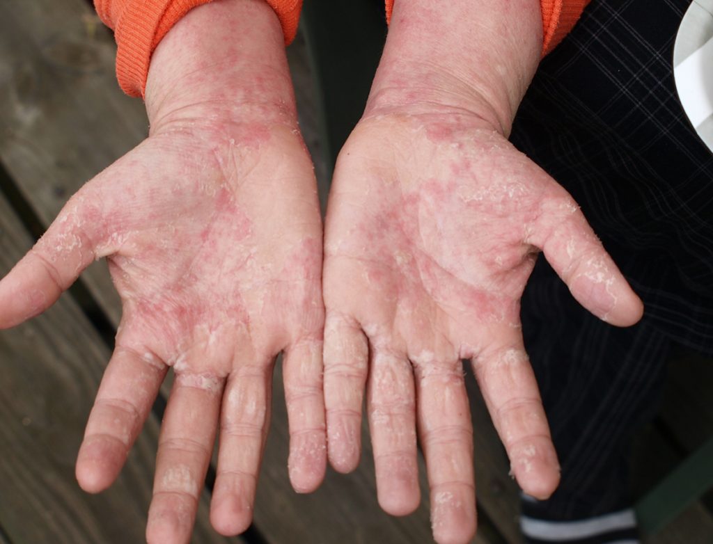 topical steroid hands 1200 Nina Ajdin has spent years battling eczema, a chronic skin condition that affects roughly 30 million Americans. (Image courtesy of Ajdin)