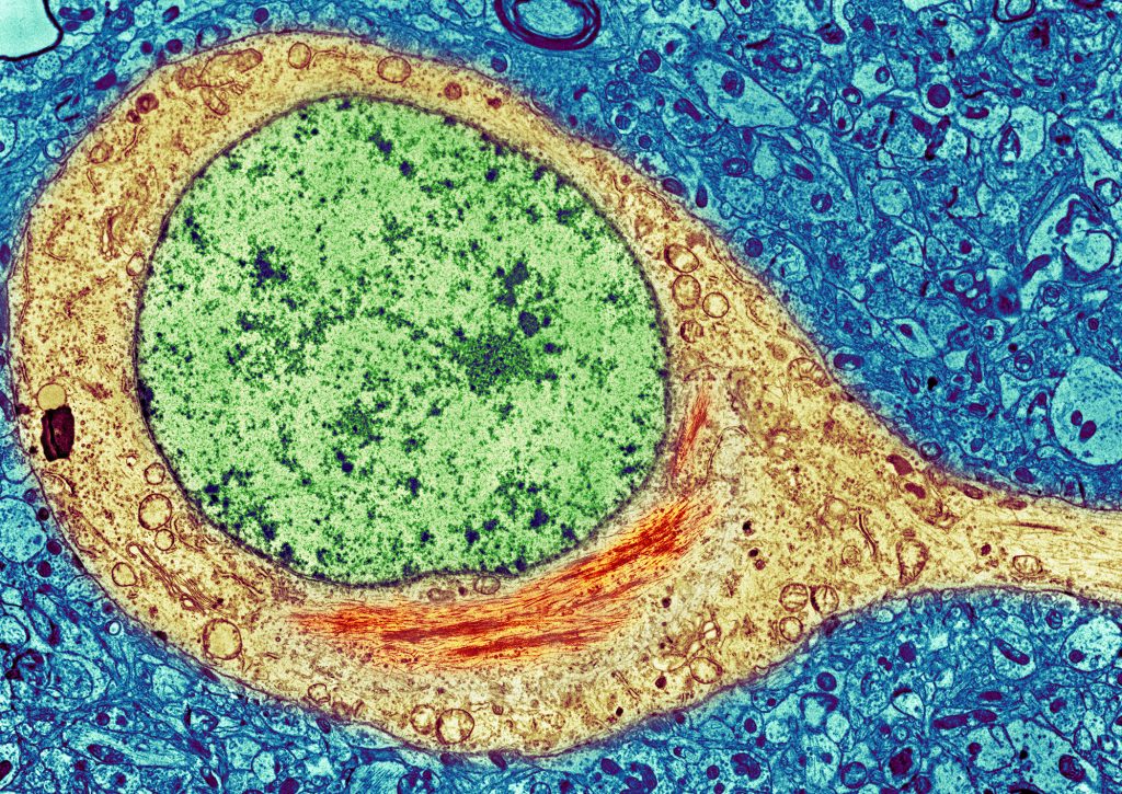 A colorized image of a brain cell from an Alzheimer’s patient shows a neurofibrillary tangle (red) inside the cytoplasm (yellow) of the cell. The tangles consist primarily of a protein called tau. A colorized image of a brain cell from an Alzheimer's patient shows a neurofibrillary tangle (red) inside the cytoplasm (yellow) of the cell. The tangles consist primarily of a protein called tau. (SPL/Science Source)