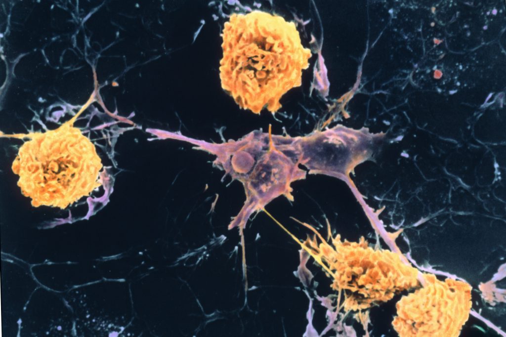 A scanning electron micrograph shows microglial cells (yellow) ingesting branched oligodendrocyte cells (purple), a process thought to occur in multiple sclerosis. Oligodendrocytes form insulating myelin sheaths around nerve axons in the central nervous system. A scanning electron micrograph shows microglial cells (yellow) ingesting branched oligodendrocyte cells (purple), a process thought to occur in multiple sclerosis. Oligodendrocytes form insulating myelin sheaths around nerve axons in the central nervous system.
(Dr. John Zajicek/Science Source)
