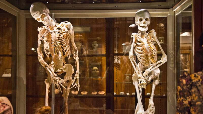 The skeletons of Harry Eastlack (left) and the newly added Carol Orzel on display at the Mütter Museum in Philadelphia. Both had Fibrodysplasia Ossificans Progressiva (FOP), a rare disorder in which connective tissue is replaced by bone. (Kimberly Paynter/WHYY)