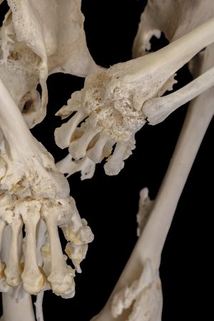 Over time, Carol Orzel's joints fused together because of the rare bone disease, fibrodysplasia ossificans progressiva, also known as FOP. (Provided)
