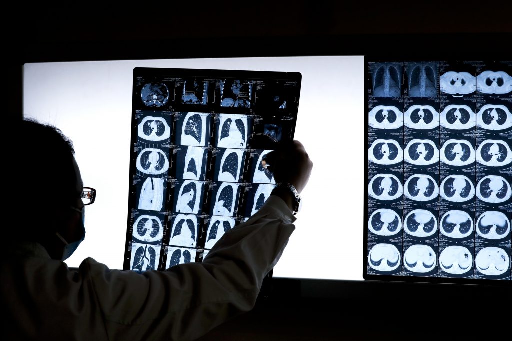 China Catching Smokers A doctor looks at the CT scan of a lung cancer patient. (Andy Wong/AP Photo)