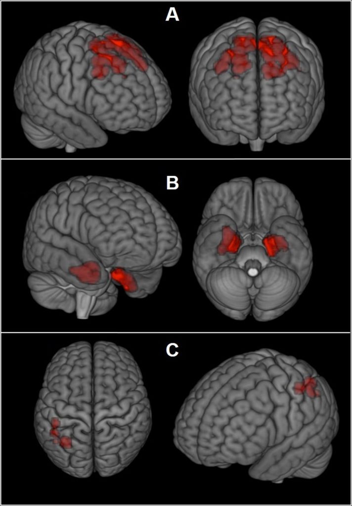 Football Concussions Brain Scans This image provided by The New England Journal of Medicine in April 2019 shows an illustration based on brain scans from former NFL players. As a group, they were found to have higher levels of an abnormal protein than a comparison group of healthy men, indicated by red patches. The protein is a hallmark of a degenerative brain disease that's been linked to repeated head blows. (The New England Journal of Medicine via AP)