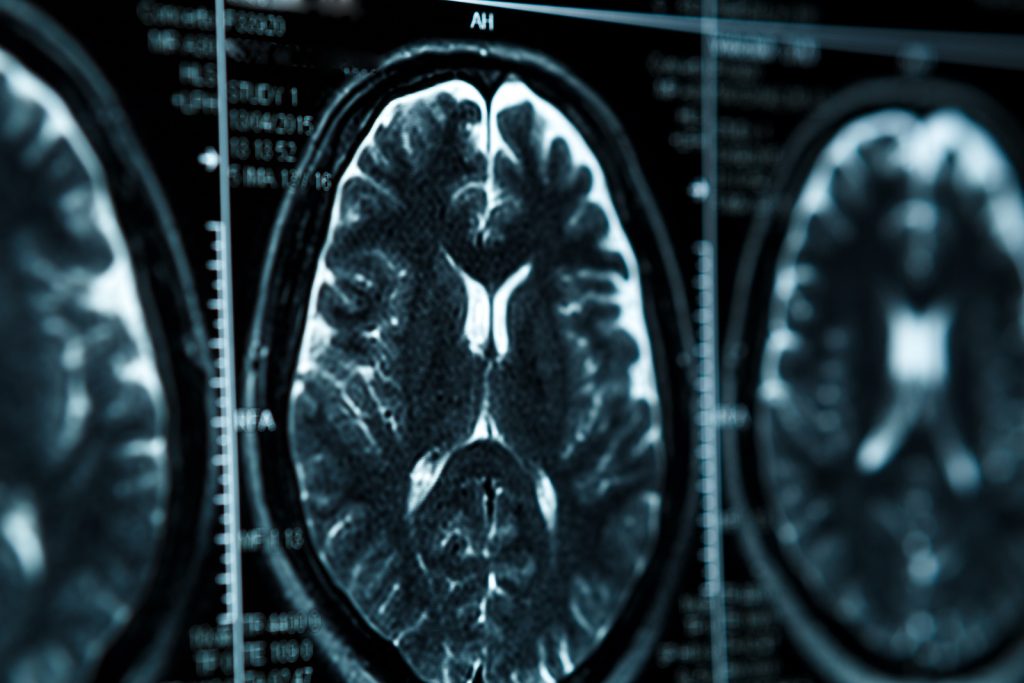 MRI scan or magnetic resonance image of head and brain scan. Close up view MRI scan or magnetic resonance image of head and brain scan. Close up view