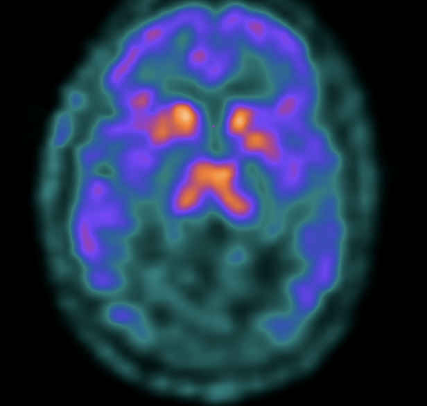 carfentanil brain image PET brain imaging of an opioid receptor binding. (Penn Medicine)