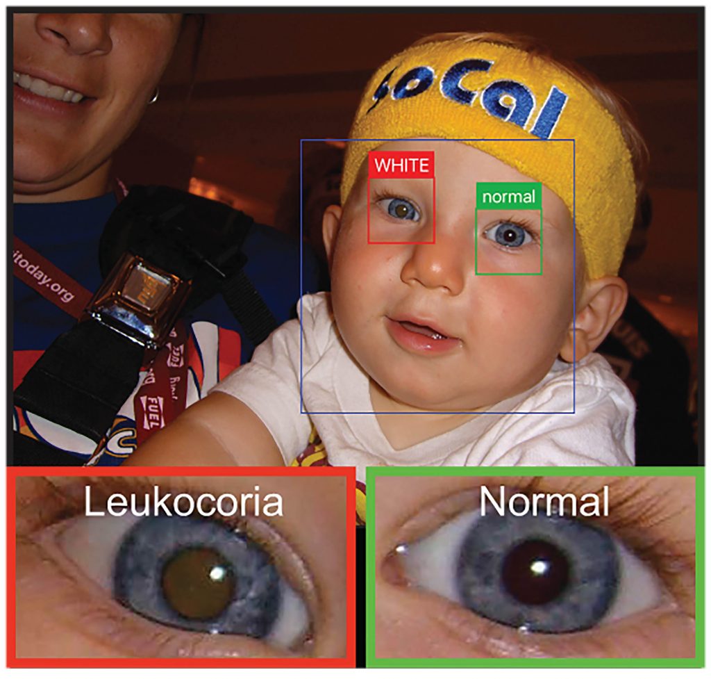 An app uses a smart phone camera to detect leukocoria, a pale reflection from the back of the eye. It can be an early sign of disease. Here it appears light brown compared the healthy eye. An app uses a smart phone camera to detect leukocoria, a pale reflection from the back of the eye. It can be an early sign of disease. Here it appears light brown compared the healthy eye. (Munson et al., Sci. Adv. 2019; 5 eaax 6363)
