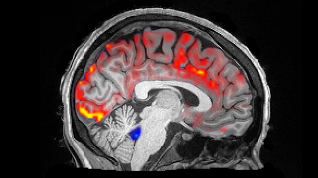During deep sleep, waves of cerebrospinal fluid (blue) coincide with temporary decreases in blood flow (red). Less blood in the brain means more room for the fluid to carry away toxins, including those associated with Alzheimer’s disease. During deep sleep, waves of cerebrospinal fluid (blue) coincide with temporary decreases in blood flow (red). Less blood in the brain means more room for the fluid to carry away toxins, including those associated with Alzheimer’s disease. (Fultz et al., 2019)