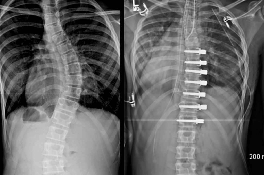 main SHRINERS Pre-Post_Tethering X-rays showing a spine with scoliosis before and after surgery. (Image courtesy of Shriners Hospitals for Children — Philadelphia)