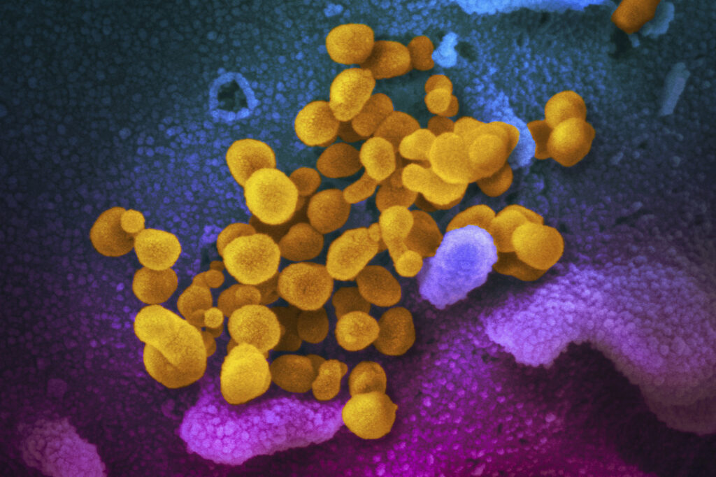 Virus Outbreak Inflammatory Condition Kids This undated electron microscope image made available by the U.S. National Institutes of Health in February 2020 shows the Novel Coronavirus SARS-CoV-2, yellow, emerging from the surface of cells, blue/pink, cultured in the lab. (NIAID-RML via AP, File)