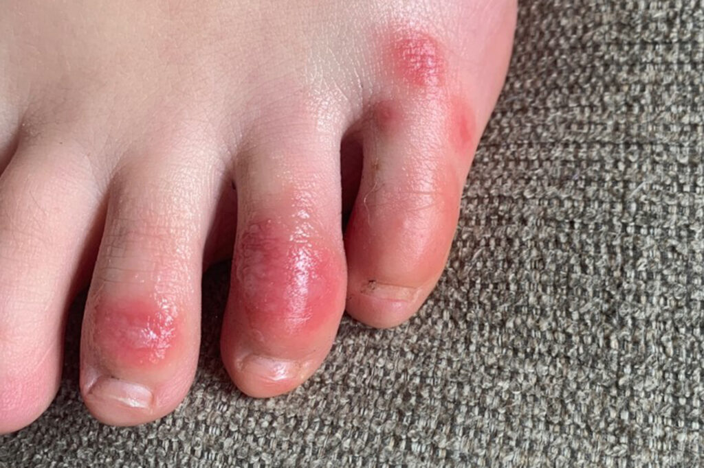 This April 3, 2020 photo provided by Northwestern University shows discoloration on a teenage patient's toes at the onset of the condition informally called 