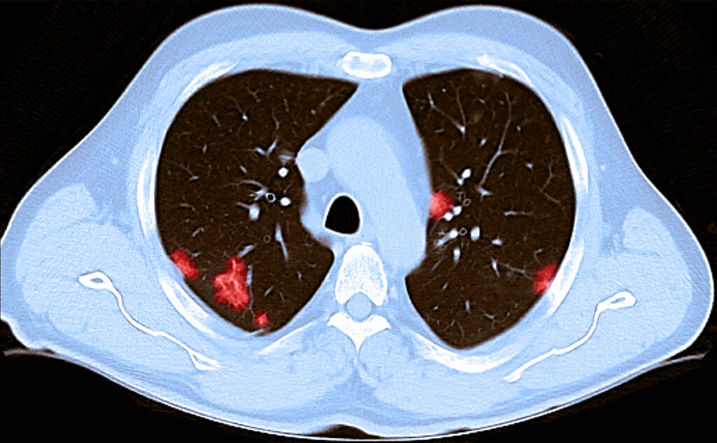 A CT Scan of the chest of a 66-year-old male reveals patchy rounded hazy spots throughout the lungs. He had tested positive for the novel coronavirus and experienced shortness of breath. A CT Scan of the chest of a 66-year-old male reveals patchy rounded hazy spots throughout the lungs. He had tested positive for the novel coronavirus and experienced shortness of breath.