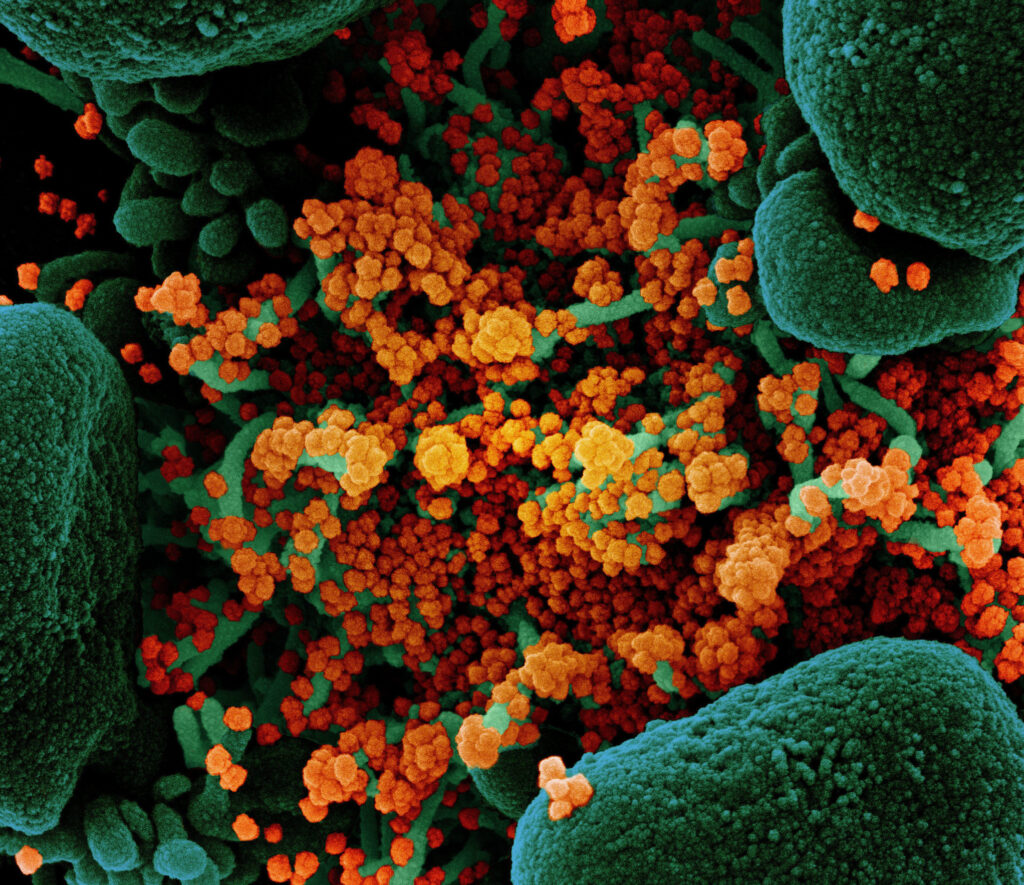 A colorized scanning electron micrograph of a cell (green) heavily infected with particles (orange) from the virus that causes COVID-19, isolated from a patient sample. A colorized scanning electron micrograph of a cell (green) heavily infected with particles (orange) from the virus that causes COVID-19, isolated from a patient sample. (NIAID)