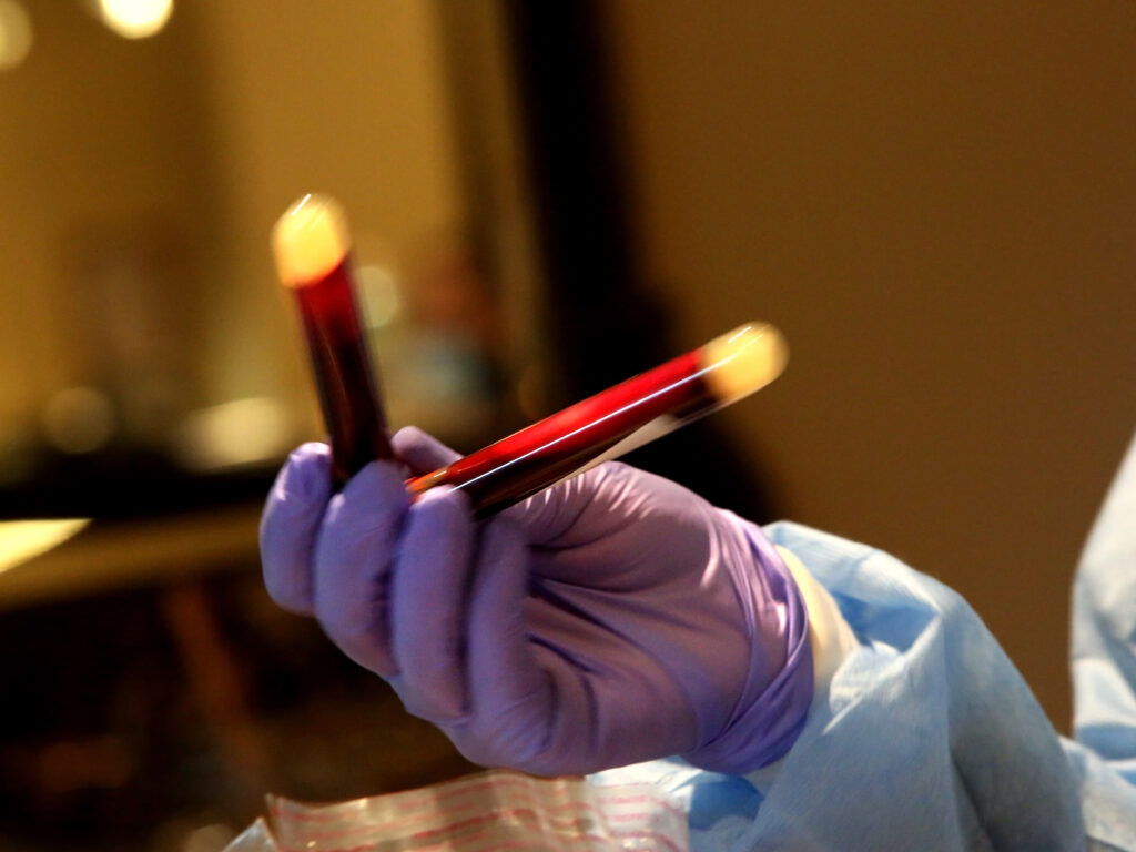 A new study that analyzed blood donations from December 2019 to early January helped show that the coronavirus infected people in the U.S. earlier than previously thought. A new study that analyzed blood donations from December 2019 to early January helped show that the coronavirus infected people in the U.S. earlier than previously thought. (Yana Paskova/Getty Images)