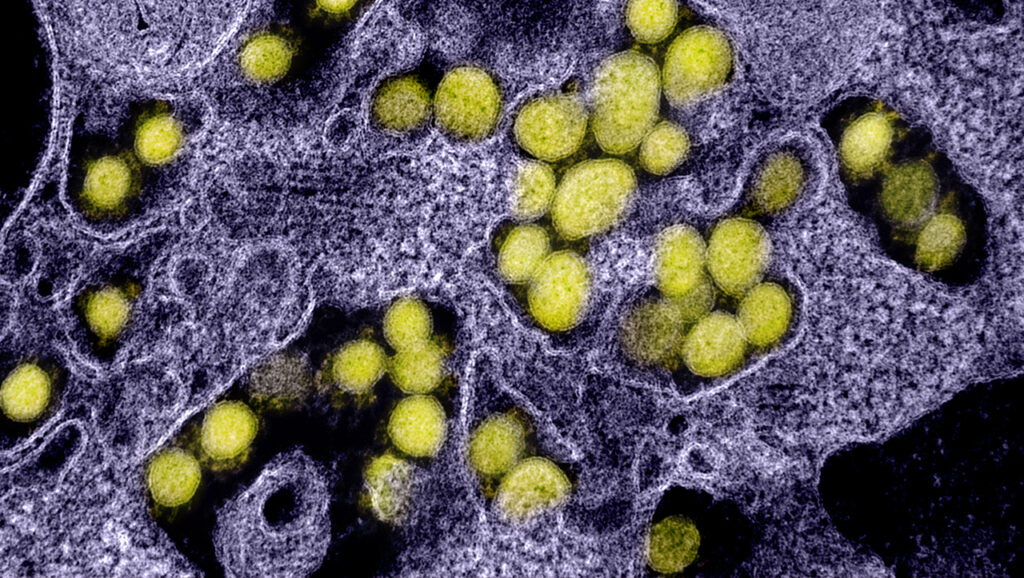 coronavirus_generic_NIH_20 Transmission electron micrograph of SARS-CoV-2 virus particles, isolated from a patient.