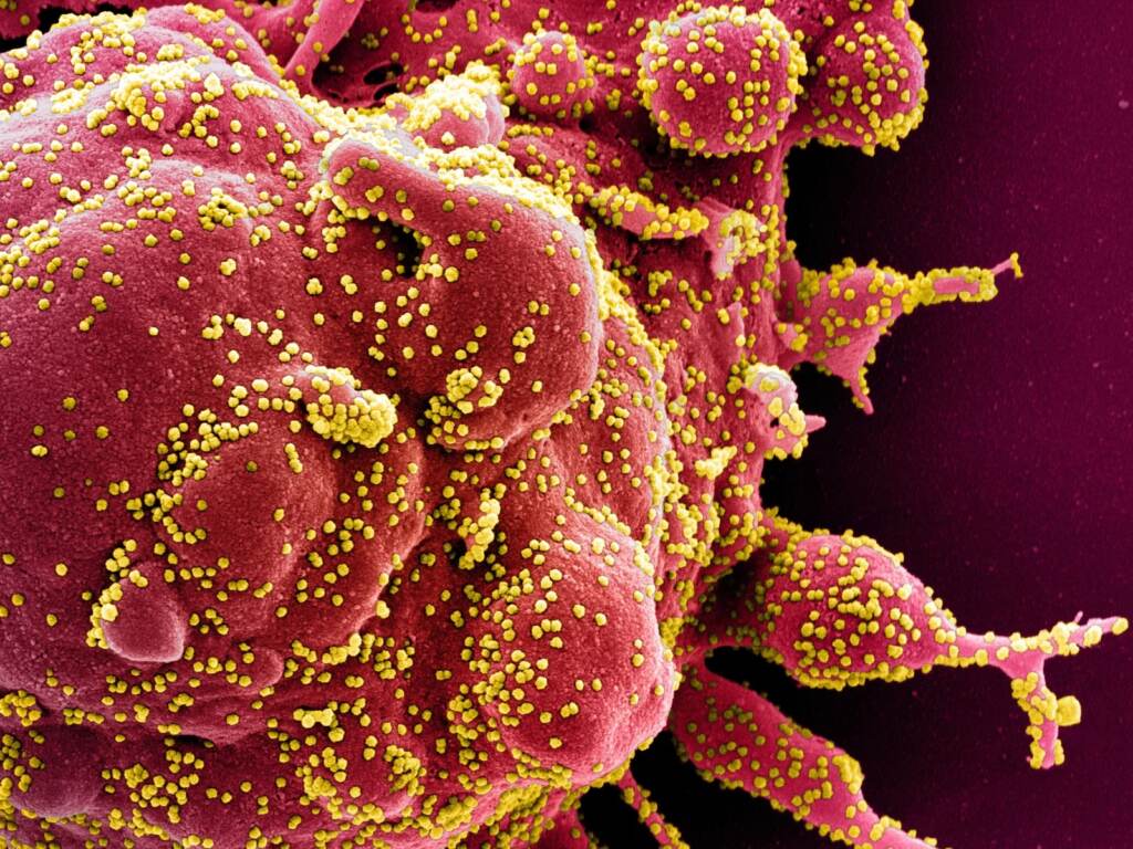 A colorized electron micrograph image of a cell (red) infected with with SARS-CoV-2 virus particles (yellow), isolated from a patient sample. Colorized scanning electron micrograph of an apoptotic cell (red) heavily infected with SARS-COV-2 virus particles (yellow), isolated from a patient sample. Image captured at the NIAID Integrated Research Facility (IRF) in Fort Detrick, Maryland. (Science Source)