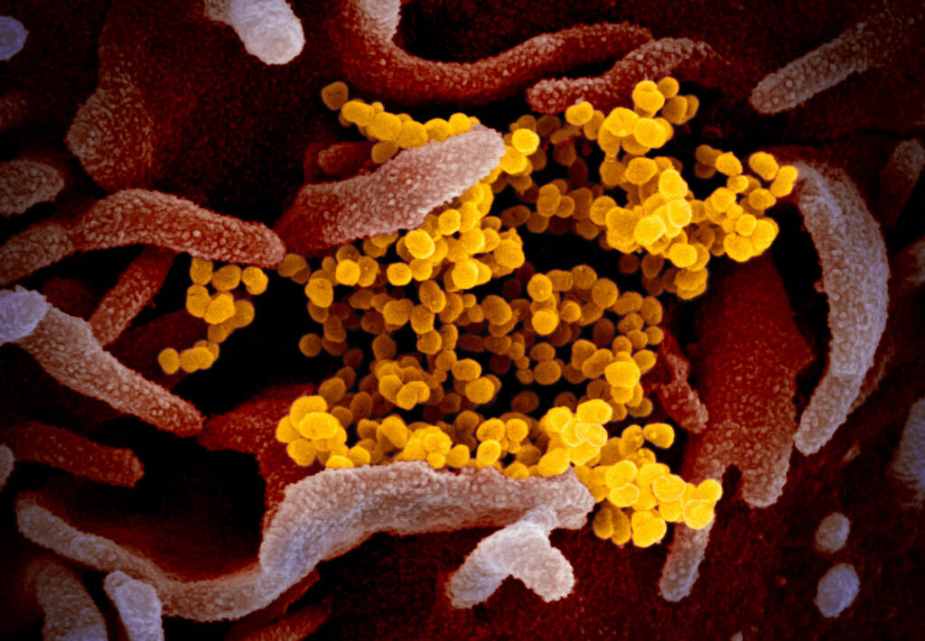 This colorized transmission electron micrograph image shows SARS-CoV-2, the coronavirus that causes the disease COVID-19. This specimen was isolated from a patient in the United States. Particles of the virus (yellow) are emerging from the surface of cells cultured in the lab (pink). This colorized transmission electron micrograph (TEM) image shows SARS-CoV-2, also known as 2019-nCoV, the virus that causes COVID-19. This specimen was isolated from a patient in the U.S. Particles of the virus (yellow) are shown emerging from the surface of cells cultured in the lab (pink). The spikes on the outer edge of the virus particles give coronaviruses their name, meaning 'crown-like'.