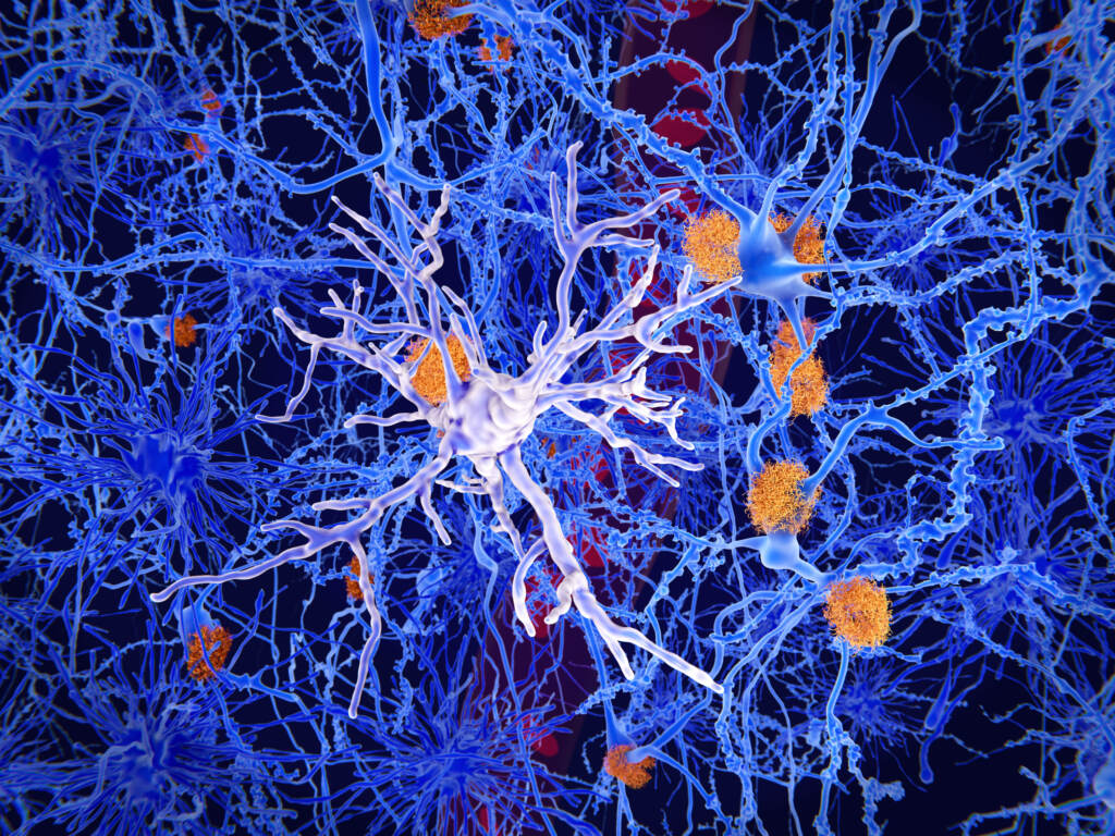 Microglia, specialized cells like the one seen in the center of this image, can restrain the accumulation of beta-amyloid protein (plaques in orange) that are a hallmark of Alzheimer’s disease. But the cells sometimes contribute to the progression of the illness, researchers say. Microglia are specialized macrophages that restrain the accumulation of ß-amyloid (plaques in orange). On the other side, once activated, they can have harmful influences in Alzheimer's disease, segregating inflammatory factors and mediating the engulfment of synapses.
