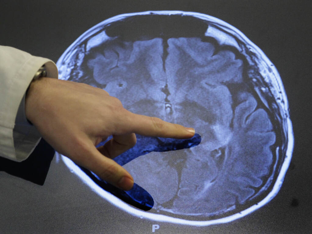 Dr. Paul Nyquist points to spots of possible damage caused by a stroke brain scan. Over the past 30 years, strokes among adults 49 and younger have increased in some parts of the U.S. Dr. Paul Nyquist points to spots of possible damage caused by a stroke brain scan. Over the past 30 years, strokes among adults 49 and younger have increased in some parts of the U.S. (Patrick Semansky/AP)