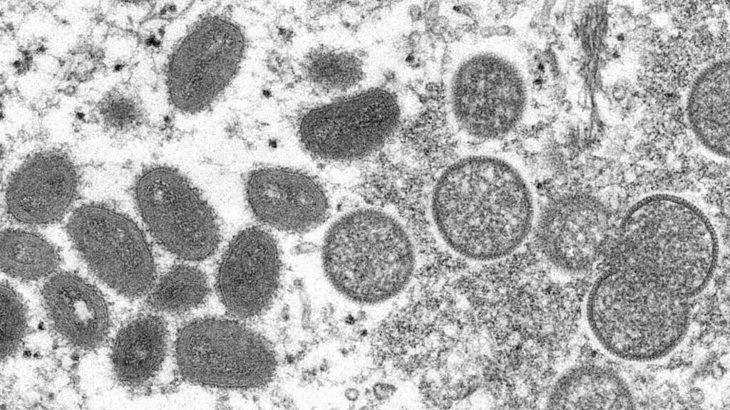This 2003 electron microscope image made available by the Centers for Disease Control and Prevention shows mature, oval-shaped monkeypox virus particles, left, and spherical immature particles, right. An electron microscope image shows monkeypox virus particles.