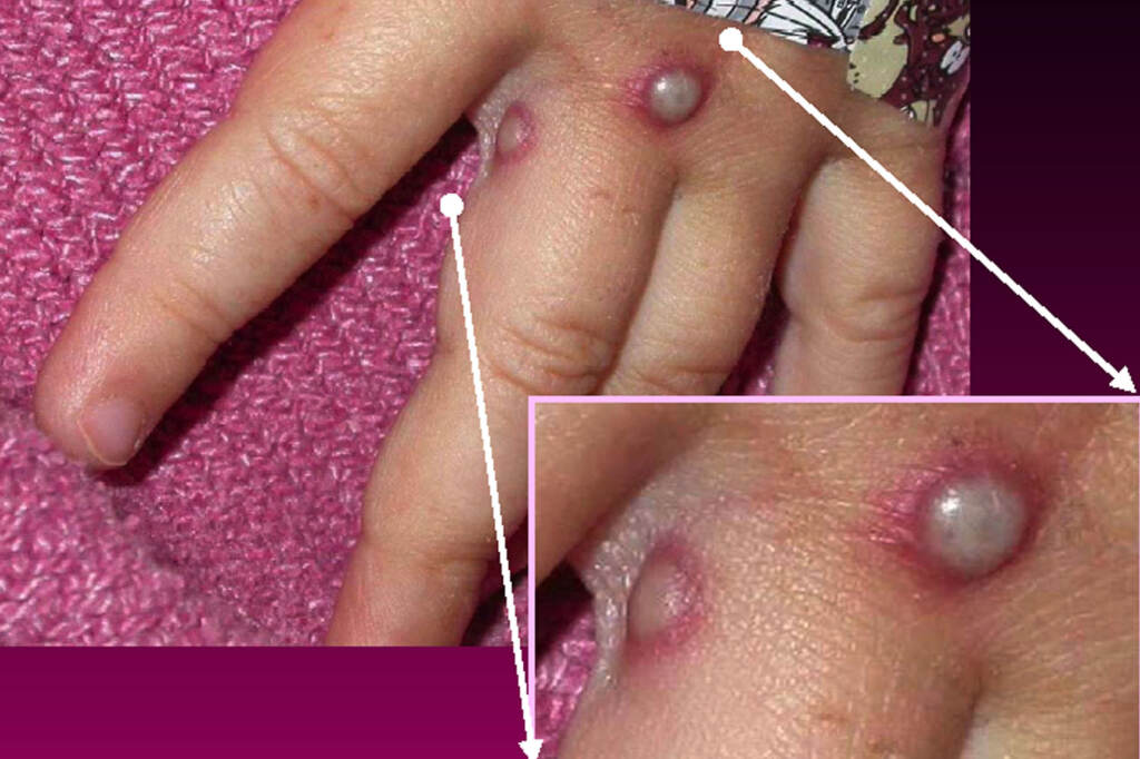 Symptoms of the monkeypox virus are shown on a patient’s hand, from a 2003 case in the United States. In most instances, the disease causes fever and painful, pus-filled blisters. New cases in the United Kingdom, Spain and Portugal are spreading possibly through sexual contact, which had not previously been linked to monkeypox transmission. Symptoms of a monkeypox virus are shown on a patient's hand