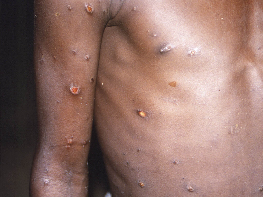 Monkeypox A patient with monkeypox lesions